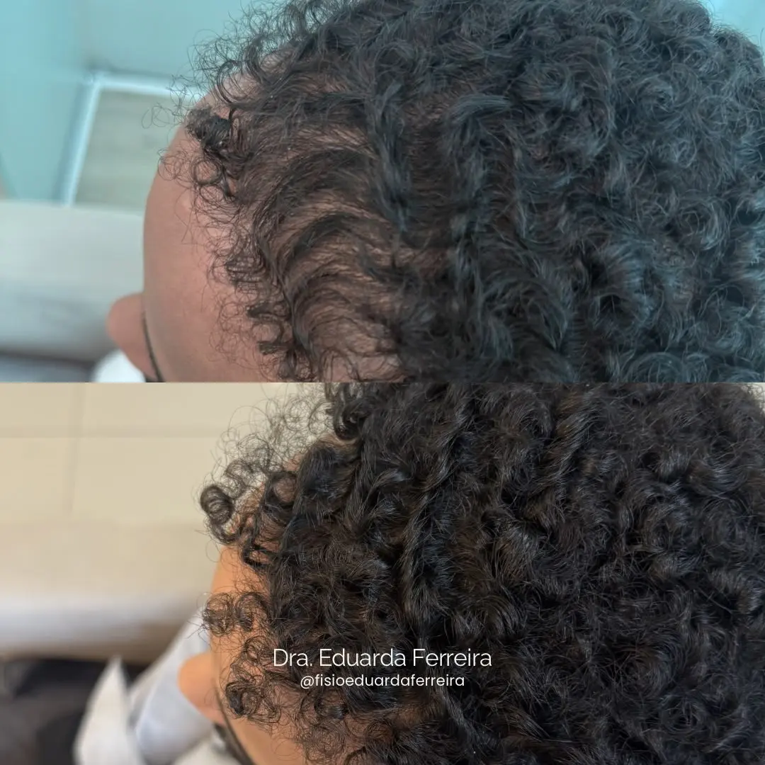 Resultado do tratamento capilar - Antes e Depois 3
